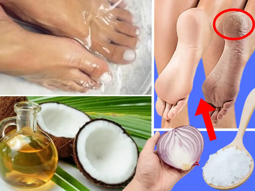 5 best natural remedies for cracked heels, home remedies for cracked heels, cracked heels home remedies, home remedy for cracked heels, natural home remedies for soft feet, cracked heels treatment home remedies, home remedies for dry heels, cracked heel home remedies, cracked heels home remedy, dry cracked heels natural remedy, cracked heels remedies, cracked heels removal home remedy, dry cracked heels home remedy, repair cracked heels fast home remedy, cure for cracked heels, repair cracked heels at home