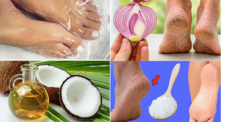 7 Natural Home Remedies for Cracked Heels (That Actually Work)