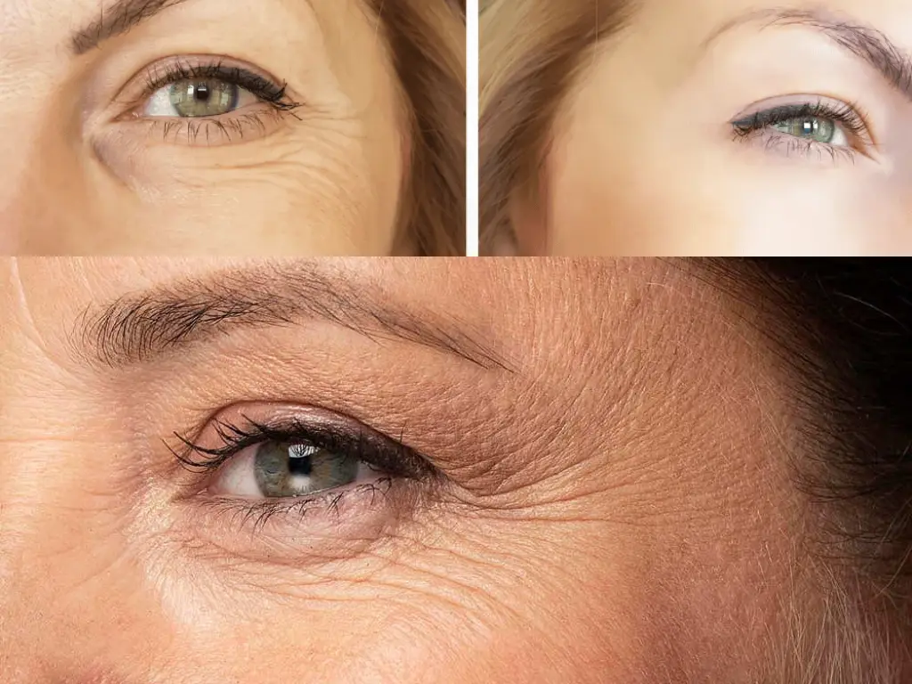 treatment of fine lines and wrinkles, wrinkles and fine lines on face treatment, fine lines and wrinkles, how to reduce fine lines and wrinkles, causes for fine lines and wrinkles, skincare for wrinkles and fine lines, fine lines treatment hindi, fine lines hindi treatment, how to fix lip lines | treatments for lip wrinkles, treating fine lines on face, treating fine lines on face hindi, wrinkles treatment hindi, wrinkles treatment, wrinkles hindi treatment, treatment of wrinkles, under eye wrinkles treatment, why is my face wrinkly