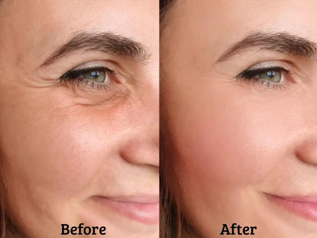 treatment of fine lines and wrinkles, wrinkles and fine lines on face treatment, fine lines and wrinkles, how to reduce fine lines and wrinkles, causes for fine lines and wrinkles, skincare for wrinkles and fine lines, fine lines treatment hindi, fine lines hindi treatment, how to fix lip lines | treatments for lip wrinkles, treating fine lines on face, treating fine lines on face hindi, wrinkles treatment hindi, wrinkles treatment, wrinkles hindi treatment, treatment of wrinkles, under eye wrinkles treatment