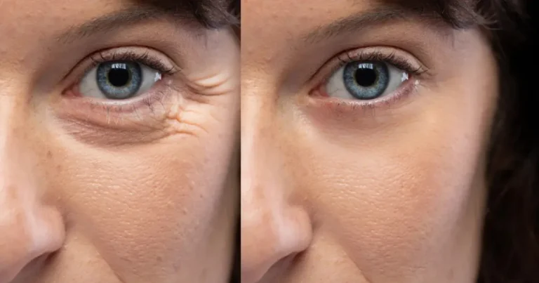 Understanding Fine Lines and Wrinkles: Causes, Differences, and Best Treatments